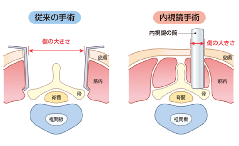 従来の手術と内視鏡手術の比較