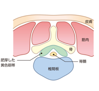 腰部脊柱管狭窄症の図（縦）