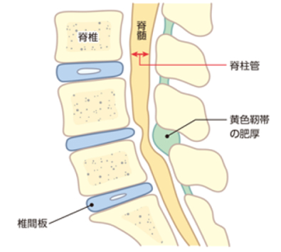 腰部脊柱管狭窄症の図（横）